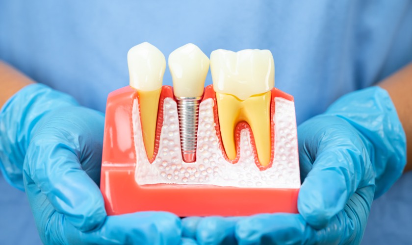 dental implants